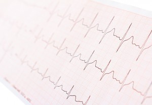 Kardiogramm EKG